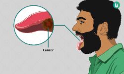 जीभ के कैंसर के उपचार की देखें नयी तकनीक