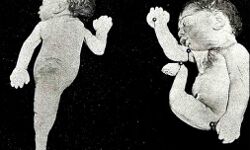 अजब-गजबः पैदा हुआ बच्चा- आधा मानव-आधी मछली