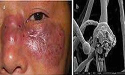 कोविड मरीज में ब्लैक फंगस पाये जाने का मामला कोविड मरीज में ब्लैक फंगस पाये जाने का मामला