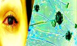 बढ़े ब्लैक फंगस के मामले बढ़े ब्लैक फंगस के मामले