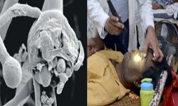 आफत पर आफत-फिर मिले ब्लैक फंगस के मरीज-संख्या हुई 87 आफत पर आफत-फिर मिले ब्लैक फंगस के मरीज-संख्या हुई 87