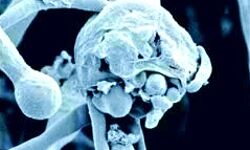 महामारियों का कहर- अब यहां भी ब्लैक फंगस की दस्तक- मरीज की मौत महामारियों का कहर- अब यहां भी ब्लैक फंगस की दस्तक- मरीज की मौत