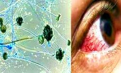 ब्लैक फंगस से महिला की मौत ब्लैक फंगस से महिला की मौत