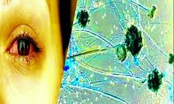 राज्य में कोरोना के साथ बढ़ रहा ब्लैक फंगस का कहर- मिले 1250 मरीज राज्य में कोरोना के साथ बढ़ रहा ब्लैक फंगस का कहर- मिले 1250 मरीज