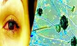 जिले में ब्लैक फंगस से दूसरी मौत जिले में ब्लैक फंगस से दूसरी मौत