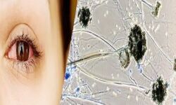 हुआ खुलासा-संक्रामक रोग नही है ब्लैक फंगस-बरते यह सावधानी हुआ खुलासा-संक्रामक रोग नही है ब्लैक फंगस-बरते यह सावधानी