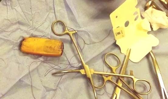 डॉक्टरों ने व्यक्ति का किया ऑपरेशन- पेट से निकला नोकिया का मोबाइल