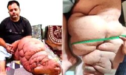 हादसे के बाद व्यक्ति का अदरक जैसा हुआ पैर- फिर डॉक्टरों ने किया चमत्कार