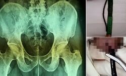 एक्सरे कर डॉक्टर रह गये हैरान- शख्स के प्राइवेट पार्ट में मिला तार