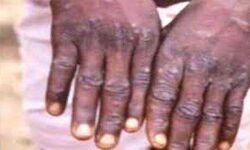 मंकीपॉक्स के मामलों की संख्या बढ़कर 297 मंकीपॉक्स के मामलों की संख्या बढ़कर 297