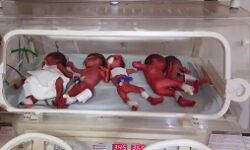 वर्षों बाद मां बनी महिला ने 5 बच्चों को दिया जन्म- मौत पर पसरा मातम