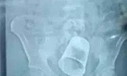 पत्नी को लेने गए दामाद की ठुकाई करने के बाद प्राइवेट पार्ट में डाला... पत्नी को लेने गए दामाद की ठुकाई करने के बाद प्राइवेट पार्ट में डाला...