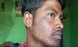 रील के लिए दांव पर जीवन- पेट्रोल भरकर उगल रहा था आग- हो गया.. रील के लिए दांव पर जीवन- पेट्रोल भरकर उगल रहा था आग- हो गया..