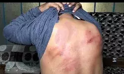 मीटर बदलने गई बिजली विभाग की टीम पर हमला- JE बुरी तरह से घायल