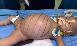 5 किलो वजन- 3 महीने की उम्र- पेट में था डेढ़ किलो का ट्यूमर फिर क्या.. 5 किलो वजन- 3 महीने की उम्र- पेट में था डेढ़ किलो का ट्यूमर फिर क्या..