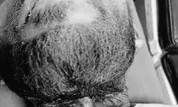 चाइनीज मांझे का कातिलाना हमला जारी- कटी युवक की गर्दन- हुआ लहूलुहान