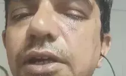 कूड़ा फेंकने से रोकने पर 3 लोगों ने तोड़ डाली प्रोफेसर की हड्डी और नाक कूड़ा फेंकने से रोकने पर 3 लोगों ने तोड़ डाली प्रोफेसर की हड्डी और नाक