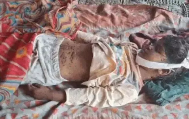दूध लेने गई बच्ची पर कुत्तों का हमला- खा गए सिर और कान- शरीर पर नहीं..