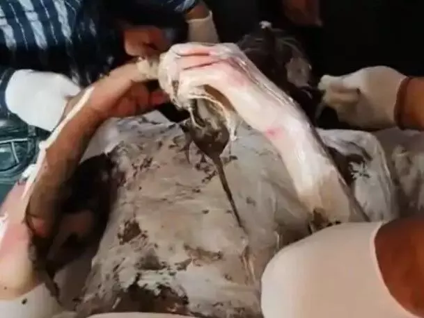 फीस जमा नहीं होने पर परीक्षा देने से रोका- छात्र ने खुद को लगाई आग