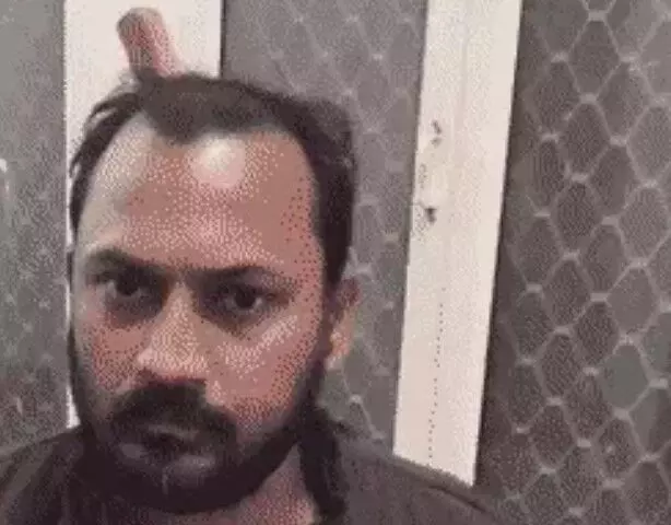 स्कूटी सवार के सिर में घोंपा सुआ- पैदल चलकर पहुंच हॉस्पिटल स्कूटी सवार के सिर में घोंपा सुआ- पैदल चलकर पहुंच हॉस्पिटल