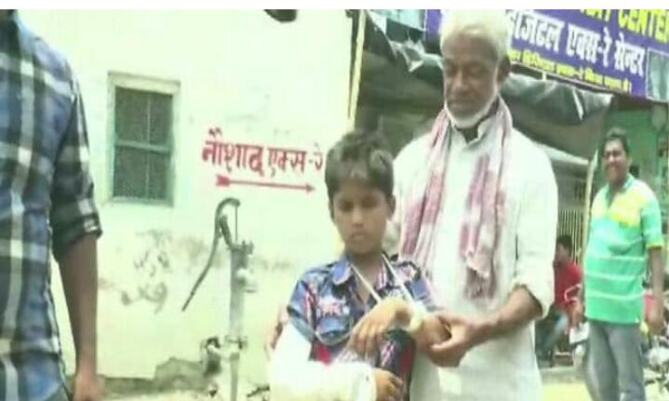 फ्रैक्चर था बायें हाथ में प्लास्टर लगा दिया दाये हाथ में