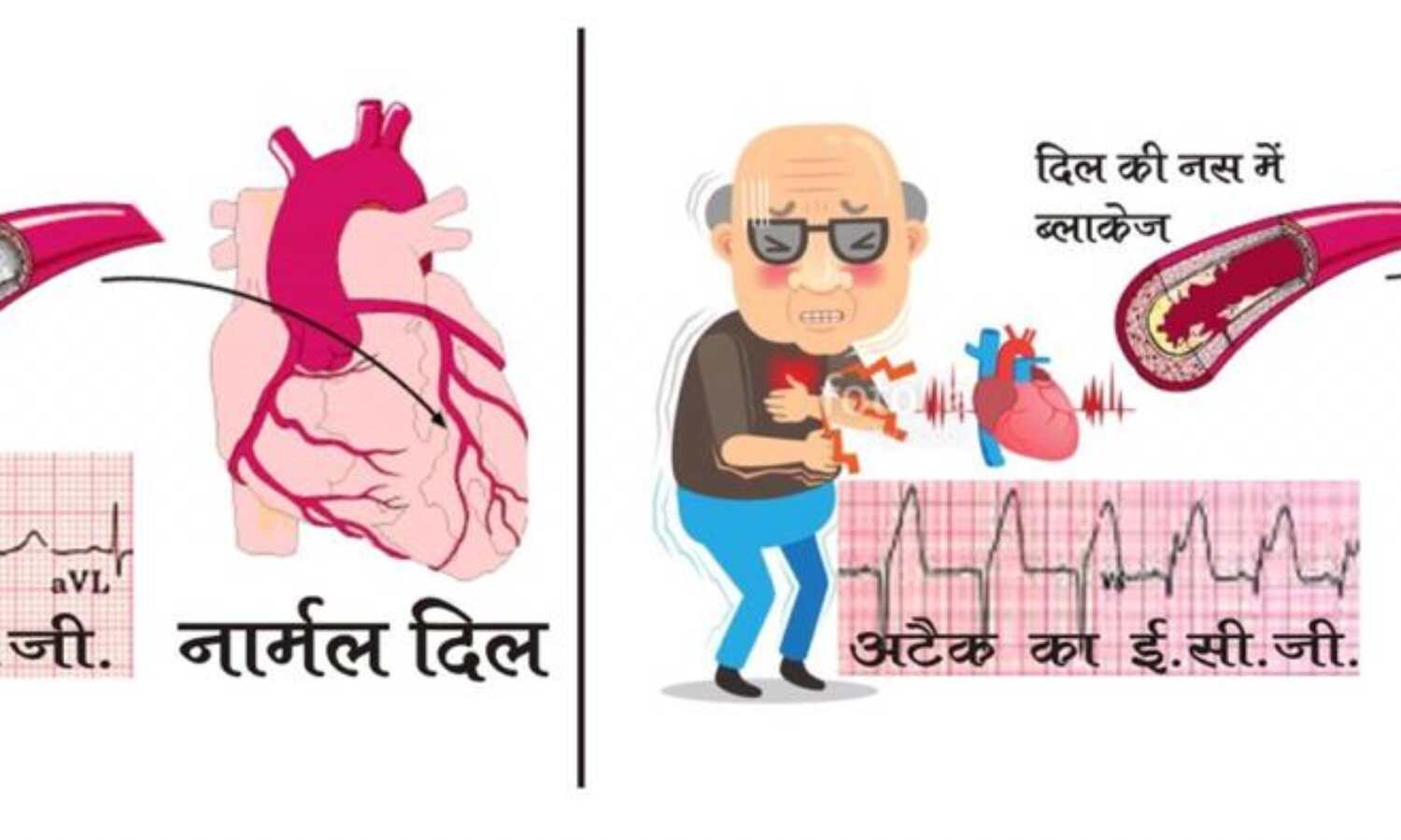 हार्ट अटैक क्या बला है : डॉ अनुभव सिंघल