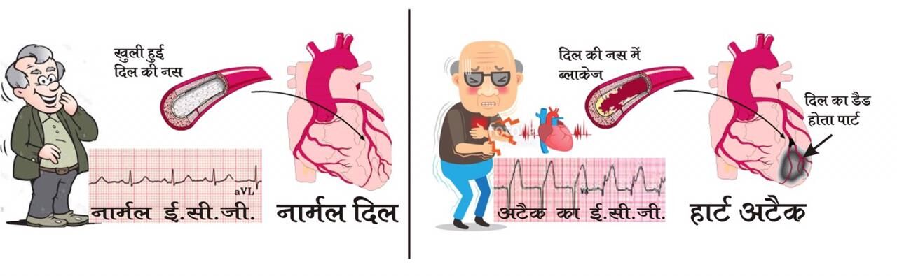 हार्ट अटैक क्या बला है : डॉ अनुभव सिंघल
